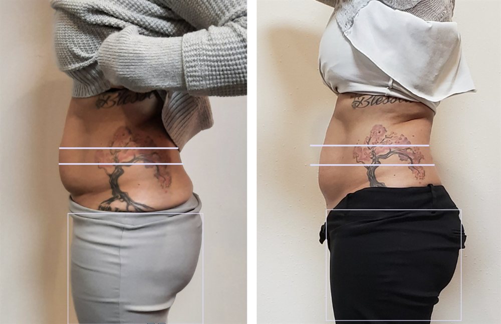 Non-Surgical abdomen fat reduction and body contouring before and after in St. Louis