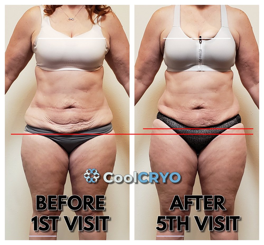 Inner and outer thigh circumference reduction without invasive procedures