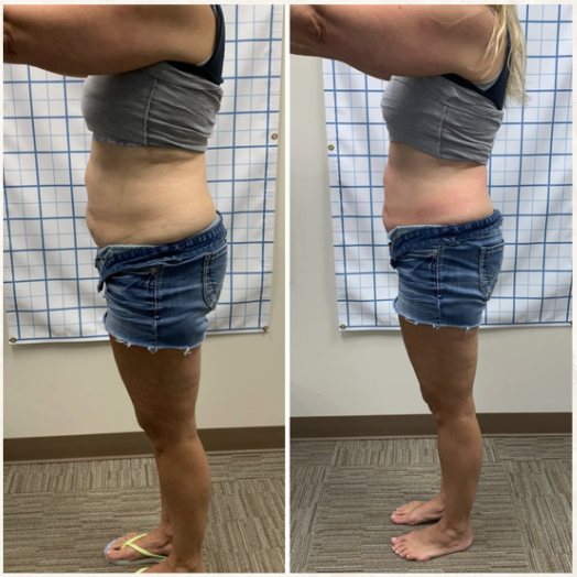 Skin tightening and cellulite smoothing results from multi-device protocol