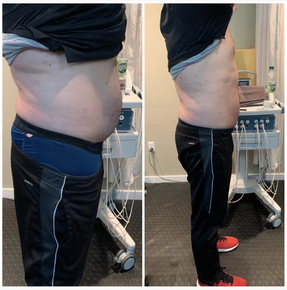 Lower stomach fat loss results after 4 sessions of CryoSculpting in Creve Coeur