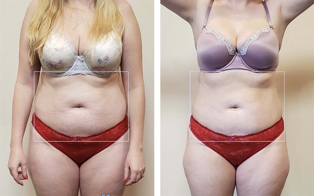 Arm fat reduction and skin tightening before after results St. Louis