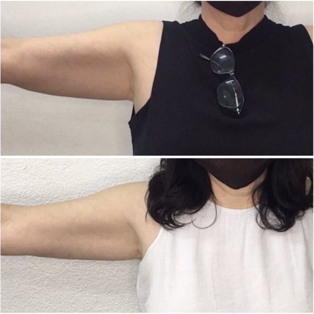 Back and bra-line fat reduction results using multi-polar RF technology