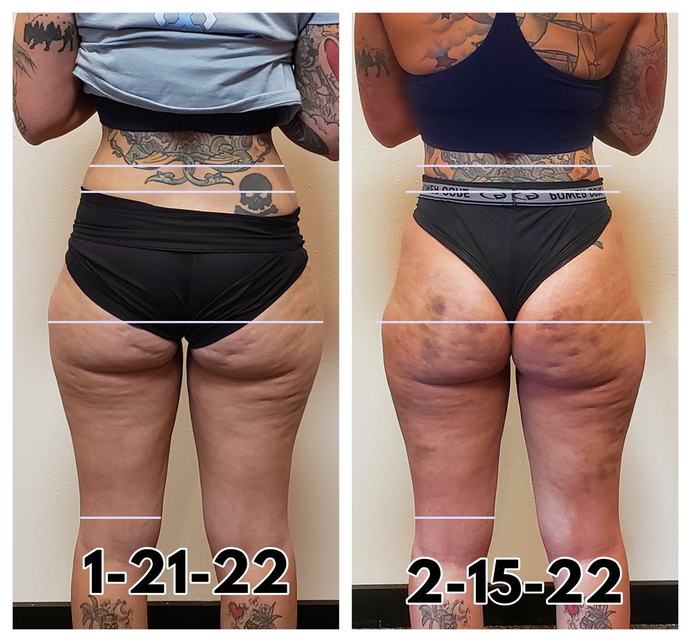 Thigh cellulite reduction and lifting before and after contouring treatments