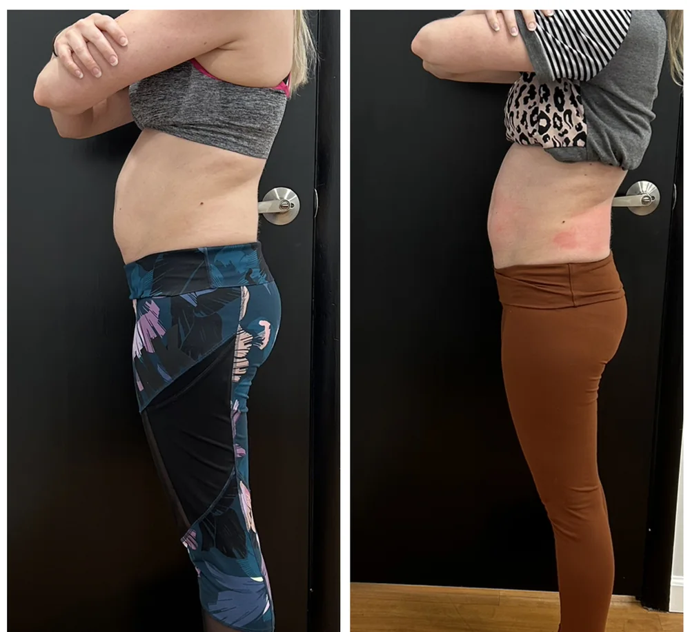 Before and After, Body Contouring Results 21 Before and after body contouring on the hip and outer thigh