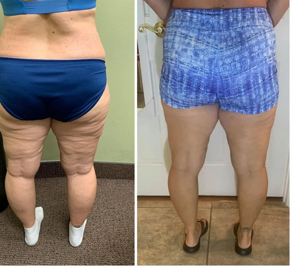 Before and After, Body Contouring Results 20 Before and after body contouring on the backs of the legs