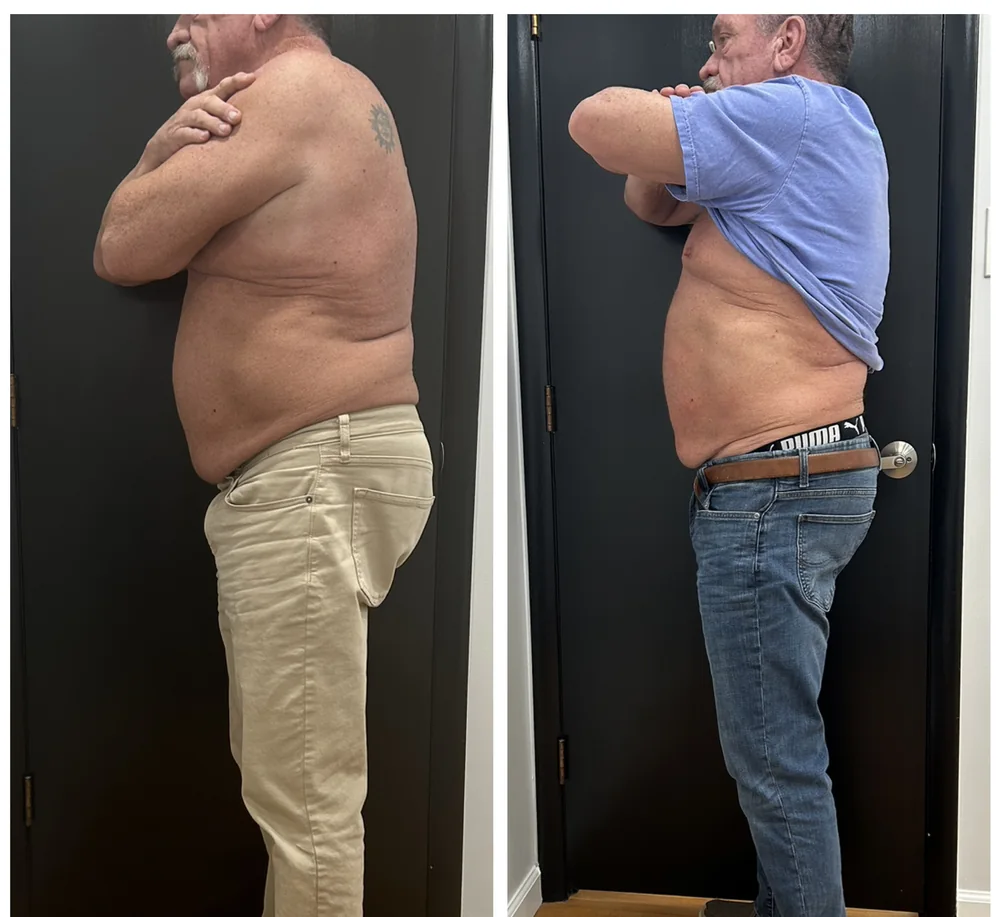 Before and After, Body Contouring Results 16 Before and after body contouring on the midsection, close side view