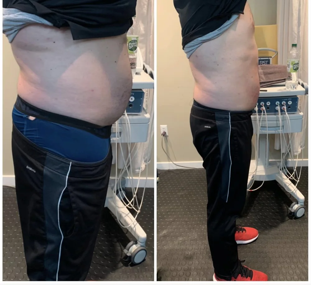 Before and After, Body Contouring Results 5 Before and after body contouring on the stomach, side view