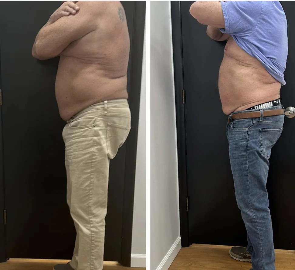 Before and After, Body Contouring Results 8 Before and after body contouring on the stomach, side view