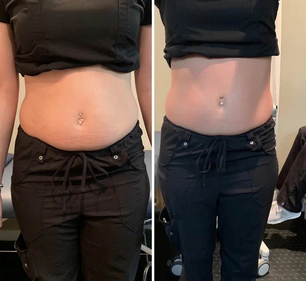 Before and After, Body Contouring Results 2 Before and after body contouring on the stomach, front view