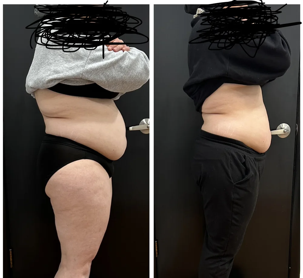 Before and After, Body Contouring Results 12 Before and after body contouring on the stomach and hip, side view