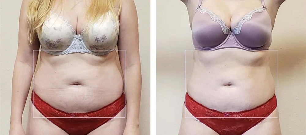Before and After, Body Contouring Results 4 Before and after body contouring on the stomach and waist