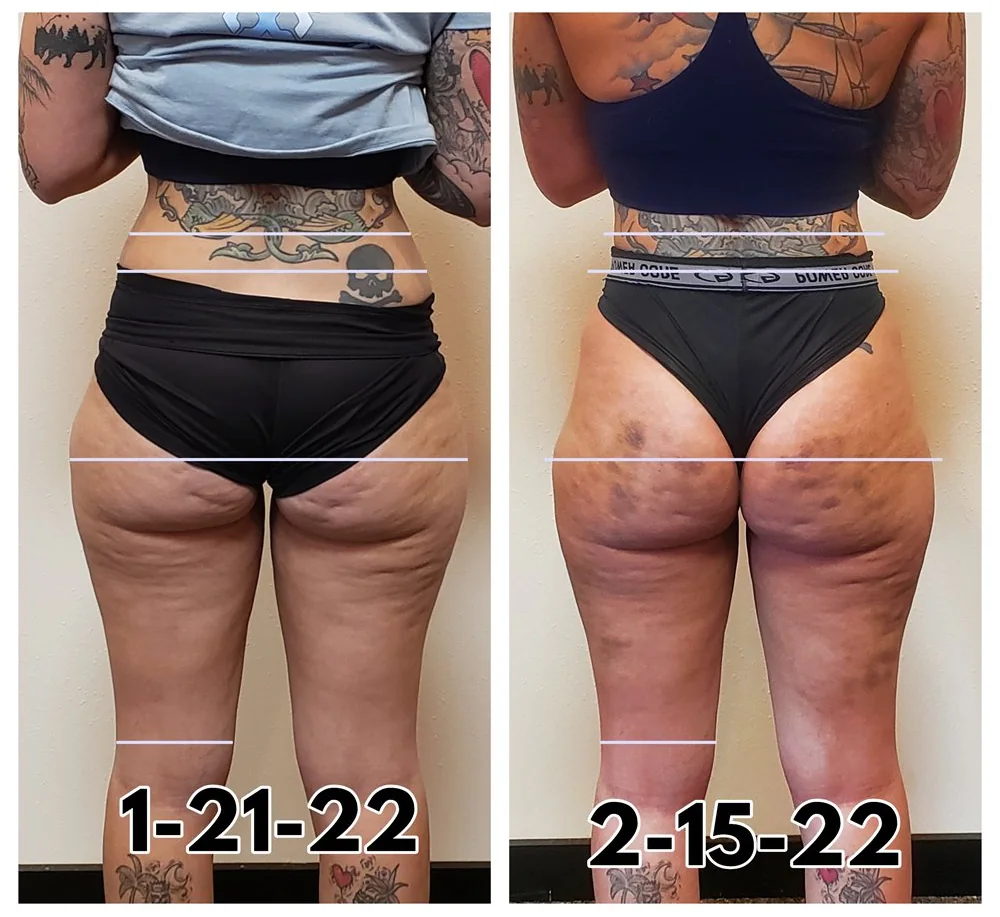 Before and After, Body Contouring Results 19 Before and after body contouring on the thighs and back of the legs