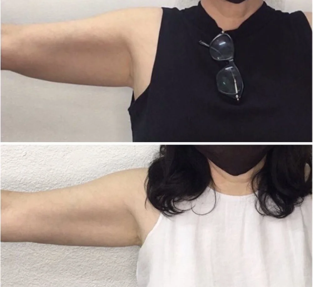 Before and After, Body Contouring Results 18 Before and after body contouring on the upper arm