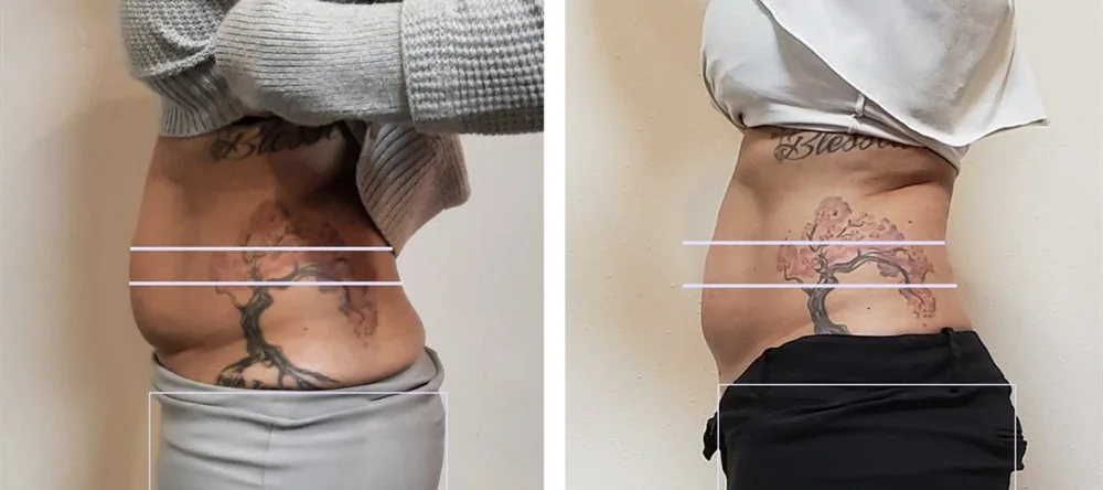Before and After, Body Contouring Results 1 Before and after body contouring on the waist, side view