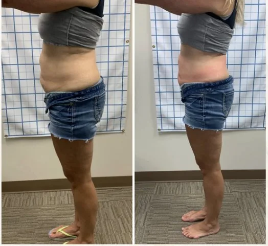 Before and After, Body Contouring Results 6 Before and after body contouring on the waist