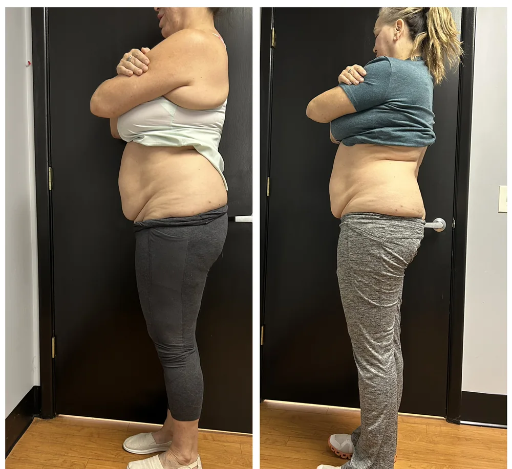 Before and After, Body Contouring Results 10 Before and after body contouring on the waist and midsection, side view