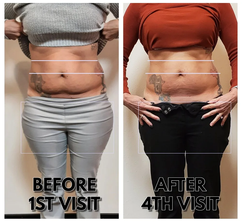 Before and After, Body Contouring Results 3 Before and after body contouring on the waist and hips after four visits