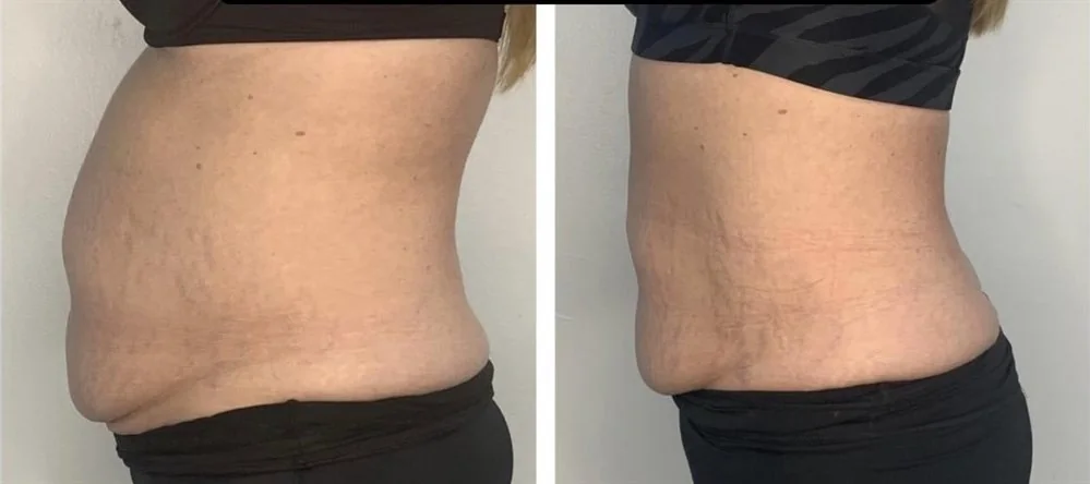 Before and After, Body Contouring Results 7 Before and after body contouring on the waistline