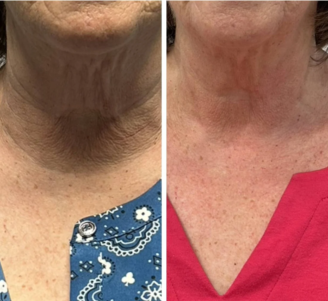 CryoFacial 2 Before and after a course of CryoFacial treatments on the neck and jawline
