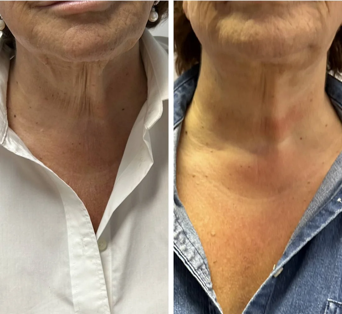 CryoFacial 3 Before and after six CryoFacial sessions on the neck and jawline