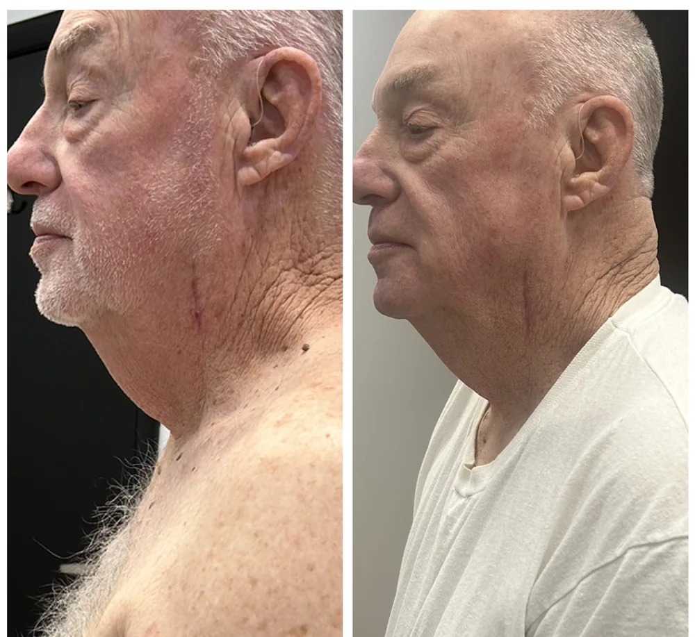 CryoFacial 4 Before and after CryoFacial treatments on the neck and jawline